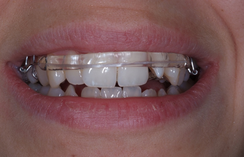 En Inman Aligner tandreglerare sedd framifrån Mun med Inman Aligner tandreglerare sedd framifrån