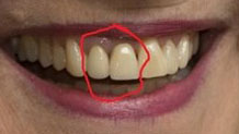 hillary-teeth